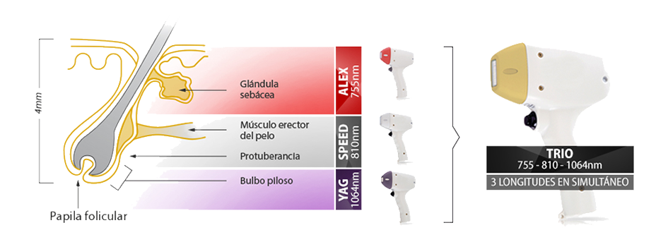 Depilación definitica soprano ice platinum